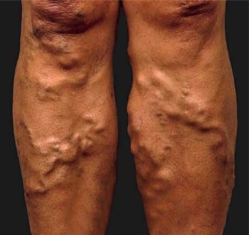 vitiligo_treatment